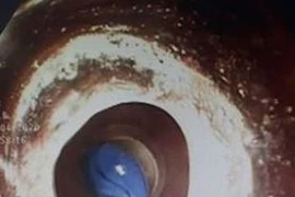 Ngậm đồ chơi, viên bi 7mm mắc tại thực quản