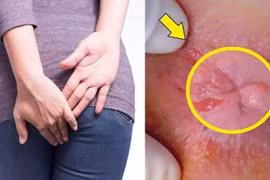 Hỏng hậu môn vì tự đi tiêm trĩ