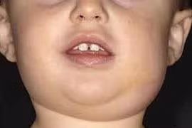 Bệnh quai bị có chữa được không?