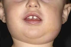 Bệnh quai bị có chữa được không?