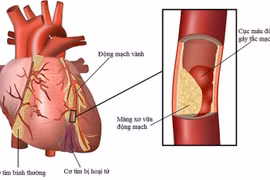 Các loại nhồi máu cơ tim