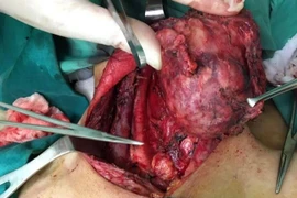 Để lâu u giáp tái phát xâm lấn nhiều nơi.