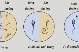 Tinh trùng dị dạng và bất động 90%