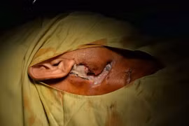 Hãi hùng loét hoại tử từ tai đến ngực do đái tháo đường