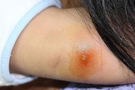 Nhiễm khuẩn huyết vì vết gai đâm