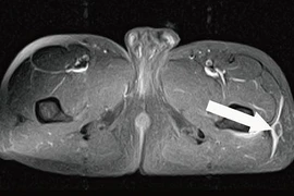 Tổn thương Morel Lavalleé