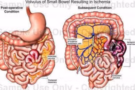 Đau bụng, nôn trớ cẩn thận hoại tử ruột