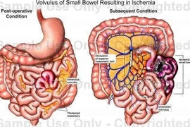 Đau bụng, nôn trớ cẩn thận hoại tử ruột