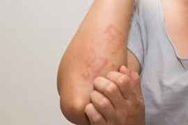 Điều trị dị ứng thực phẩm ở trẻ nhỏ