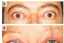 Thuốc Statin có tác dụng điều trị bệnh mắt do Basedow