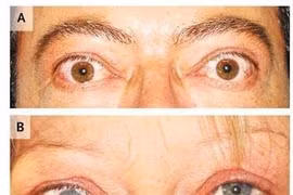 Thuốc Statin có tác dụng điều trị bệnh mắt do Basedow