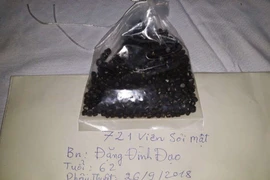 Cứu bệnh nhân có 721 viên sỏi trong túi mật