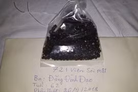 Cứu bệnh nhân có 721 viên sỏi trong túi mật