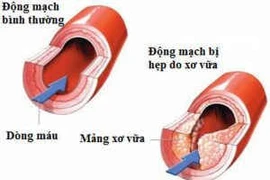 Xơ vữa mạch vì không uống thuốc