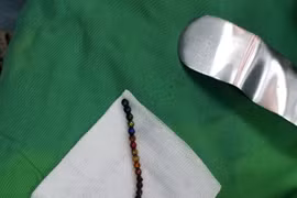 Cấp cứu bé trai nuốt 25 viên bi nam châm gây tắc và thủng ruột