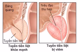 Tiểu đau và niệu đạo có mủ là biểu hiện của bệnh gì?