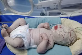 Bé trai sinh non mắc bệnh hiếm gặp, màng trắng bao bọc toàn thân