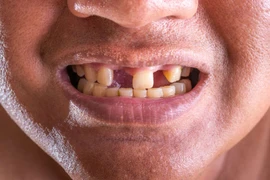 Các nhà khoa học tìm ra cách có thể giúp con người mọc lại răng