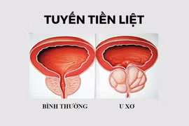 Bài thuốc trị u xơ tiền liệt tuyến