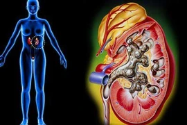  Sốt cao + tiểu bất thường dễ viêm thận bể thận cấp