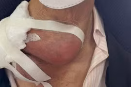 Chủ quan không chữa hạch thành di căn