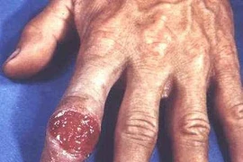 Có thể chữa khỏi bệnh giang mai?