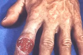 Có thể chữa khỏi bệnh giang mai?