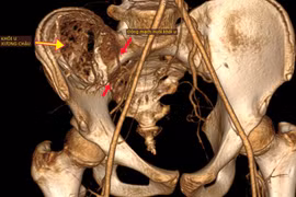 Nút mạch lấy u máu khổng lồ trong xương chậu cho trẻ 12 tuổi