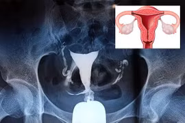 Tại sao phải chụp tử cung, vòi trứng?