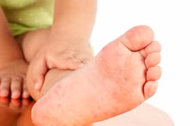 Viêm da cơ địa, phải kiên trì điều trị