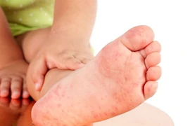 Viêm da cơ địa, phải kiên trì điều trị