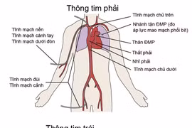  Chuẩn bị trước khi thông tim