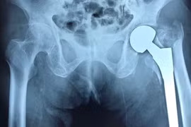 Gãy xương vùng khớp háng ở người cao tuổi: Chưa được quan tâm đúng mức?