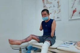 Bệnh nhân bị bỏng điện Tạ Công Hậu đã được đo ni lắp chân