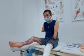 Bệnh nhân bị bỏng điện Tạ Công Hậu đã được đo ni lắp chân