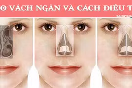  Vẹo vách ngăn vì chủ quan với nghẹt mũi 