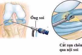 Điều trị tổn thương sụn chêm