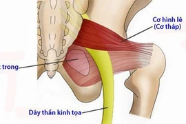 Hội chứng cơ tháp