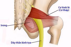 Hội chứng cơ tháp