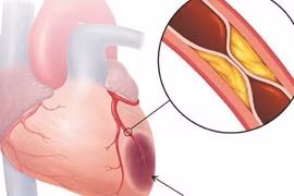Chụp động mạch vành qua ống thông