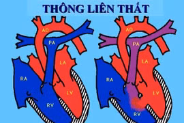 Cách điều trị các thể bệnh thông liên