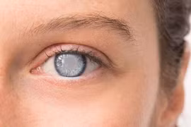 Tiểu đường + huyết áp cao= đục thủy tinh thể 