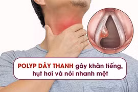 Polyp dây thanh và cách khắc phục hiệu quả từ thảo dược