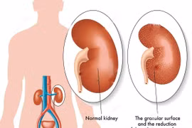 Điều trị hội chứng thận hư