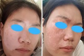 Ghép tế bào gốc tự thân điều trị bạch biến