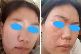 Ghép tế bào gốc tự thân điều trị bạch biến