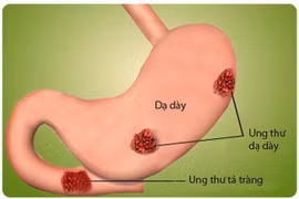 Siêu âm nội soi giúp chẩn đoán giai đoạn ung thư đường tiêu hóa 