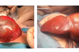 Các bác sĩ Bệnh viện Nhi đồng 1 TPHCM cắt u gan cho trẻ sơ sinh