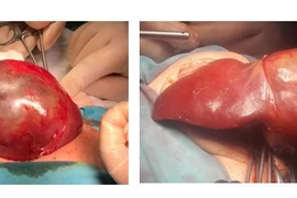 Các bác sĩ Bệnh viện Nhi đồng 1 TPHCM cắt u gan cho trẻ sơ sinh