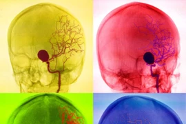 Các phương pháp chẩn đoán mạch máu não